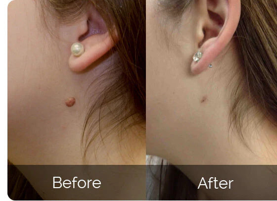 Kit ClearTag – Fini les excroissances cutanées