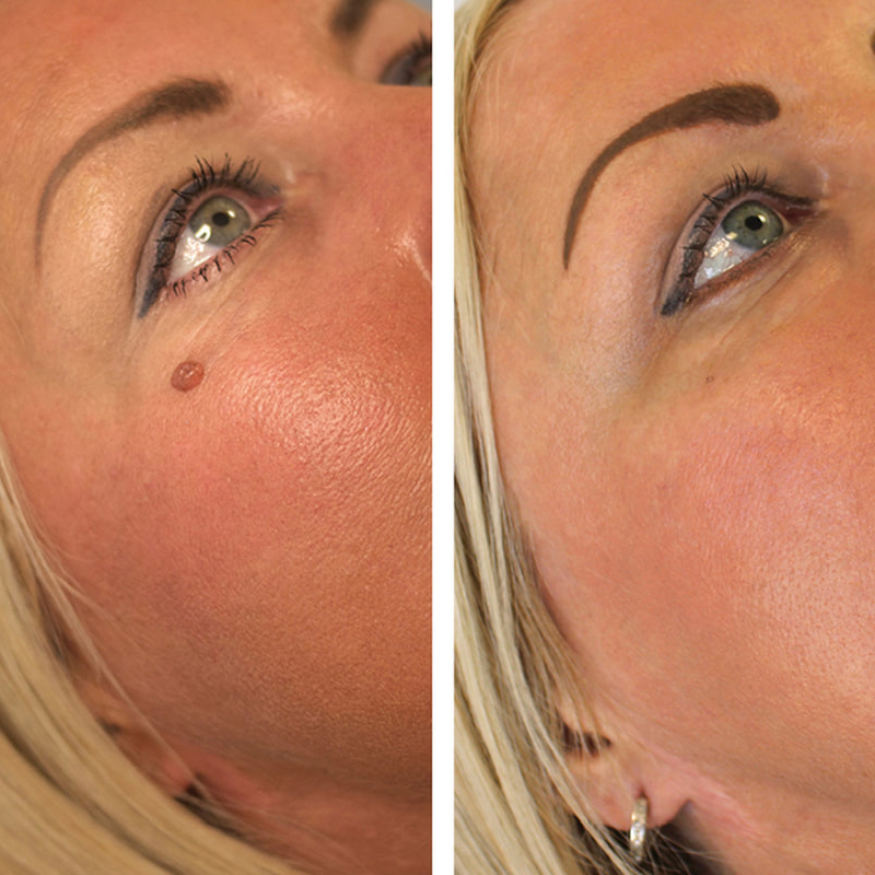 Kit ClearTag – Fini les excroissances cutanées