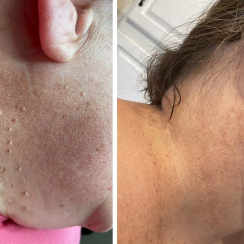 Kit ClearTag – Fini les excroissances cutanées