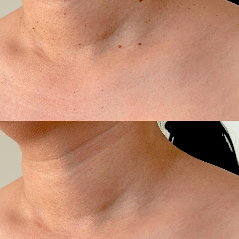 Kit ClearTag – Fini les excroissances cutanées