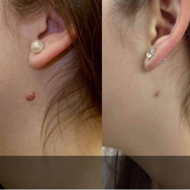 Kit ClearTag – Fini les excroissances cutanées