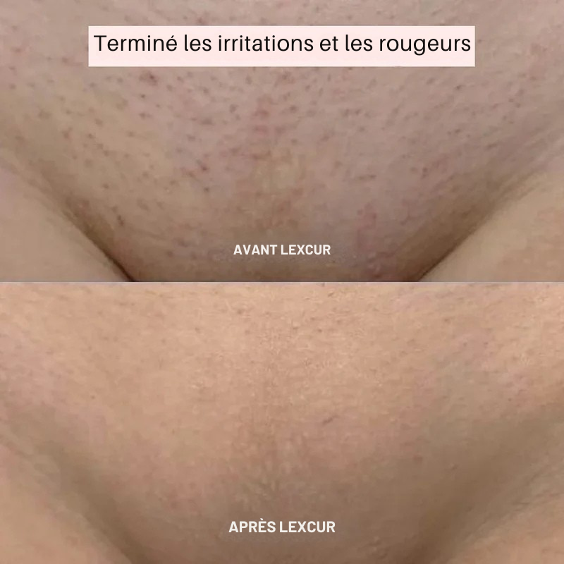 Rasoir LEXCUR® - L’innovation du rasage pour une peau lisse et éclatante